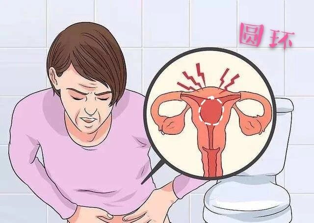 女性绝经后取环报销吗,58岁绝经4年女性取环后关注事项