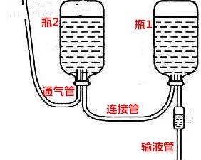 静脉输液利用大气压,应急情况下静脉输液操作示范
