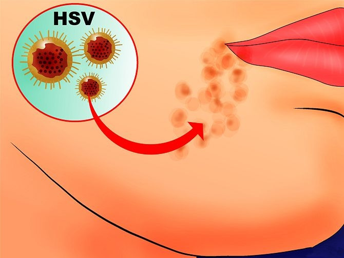 嘴角疱疹病毒每年都会复发吗,嘴角起病毒疱疹