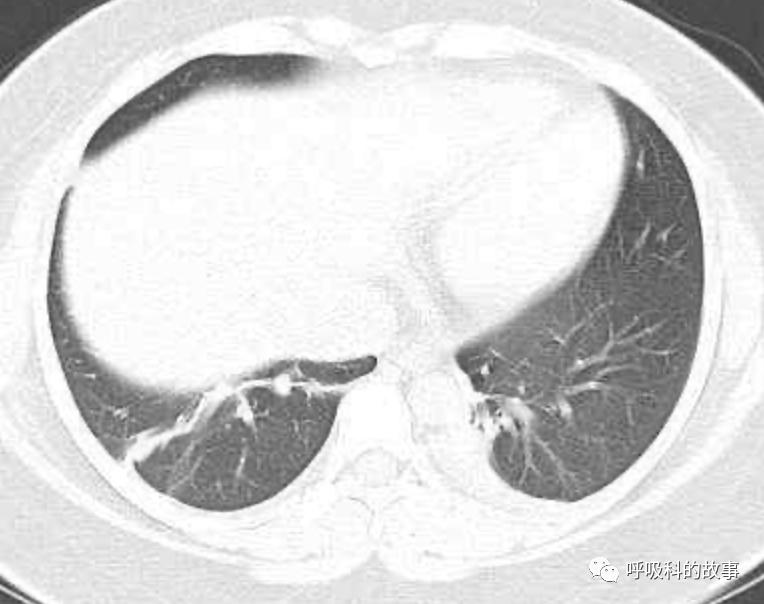 五花八门的发热之一—药物热（1）