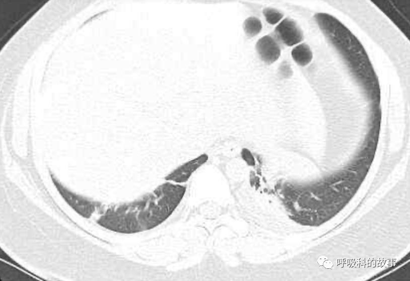 五花八门的发热之一—药物热（1）