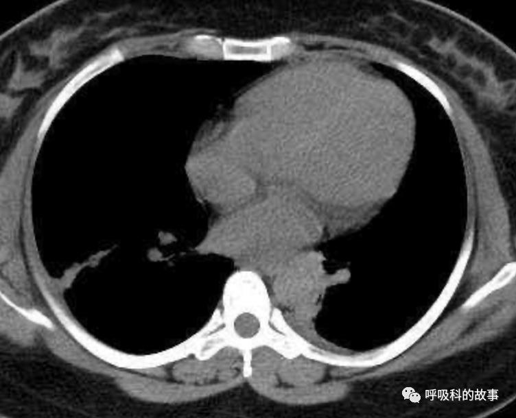 五花八门的发热之一—药物热（1）