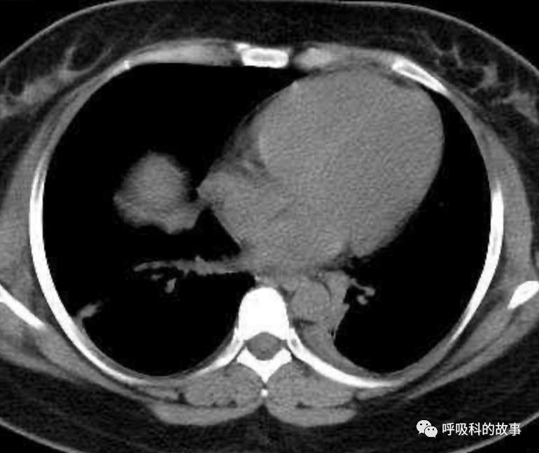 五花八门的发热之一—药物热（1）