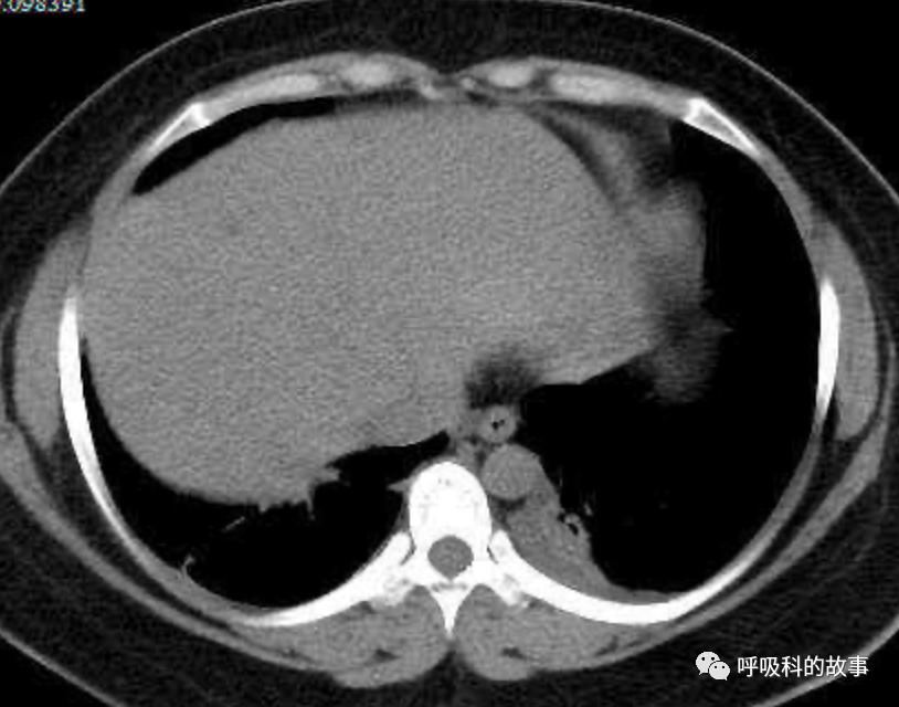 五花八门的发热之一—药物热（1）