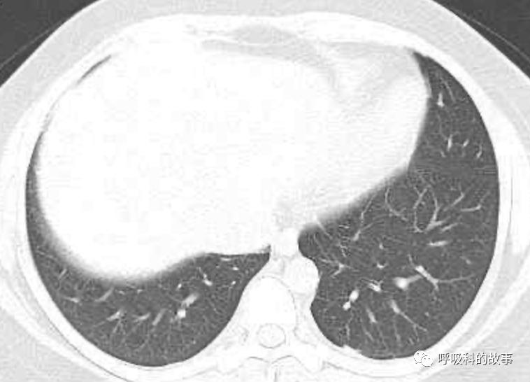 五花八门的发热之一—药物热（1）