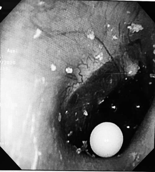3-6岁儿童益智弹珠,4岁小孩吞下塑料弹珠能排出来吗