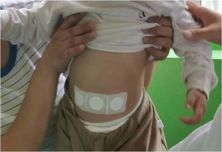 富源县中医医院“冬病夏治”三伏贴治疗即将开始