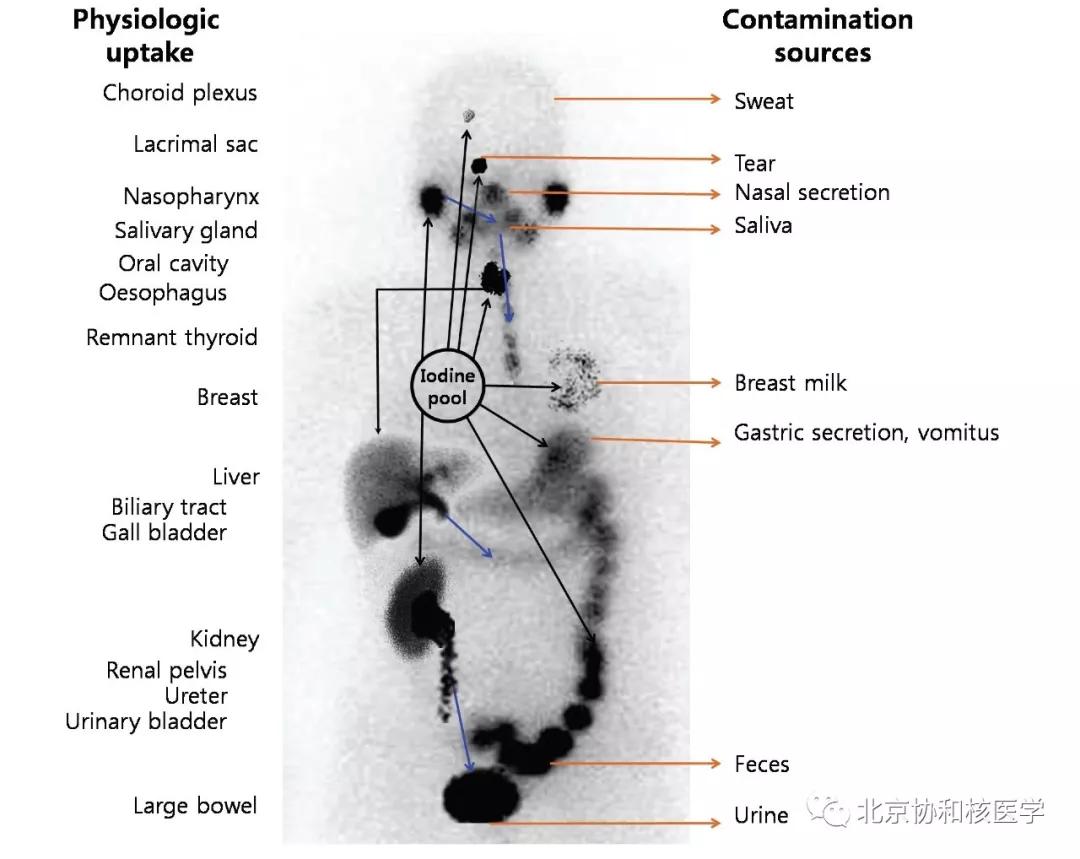 碘扫描最坏的结果,放射性核素扫描可以鉴别诊断吗