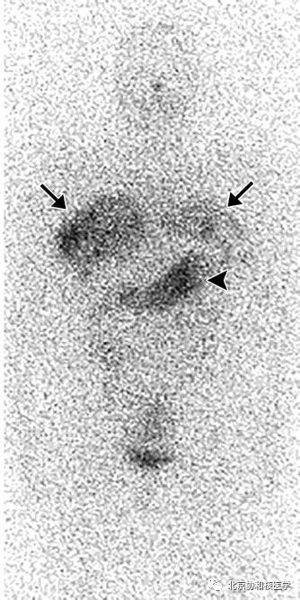 碘扫描最坏的结果,放射性核素扫描可以鉴别诊断吗
