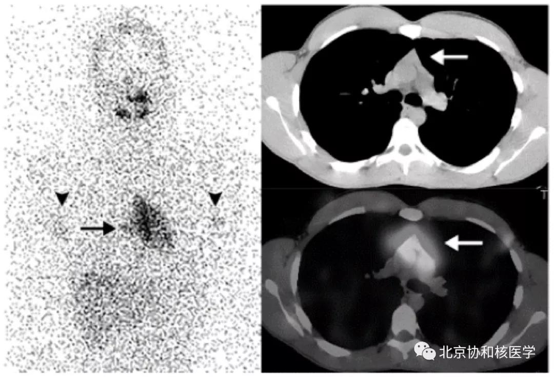 碘扫描最坏的结果,放射性核素扫描可以鉴别诊断吗