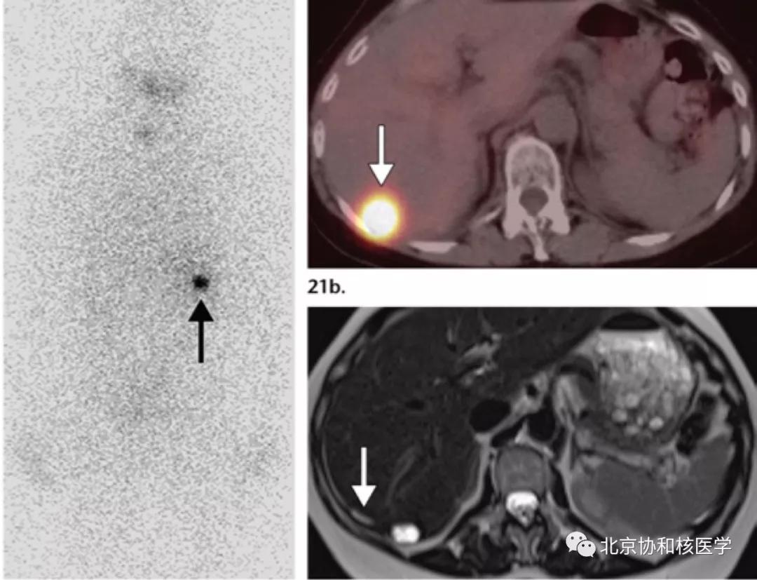 碘扫描最坏的结果,放射性核素扫描可以鉴别诊断吗