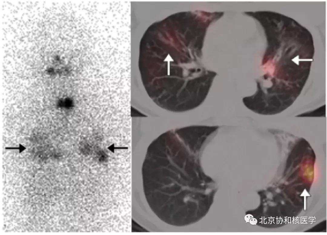 碘扫描最坏的结果,放射性核素扫描可以鉴别诊断吗