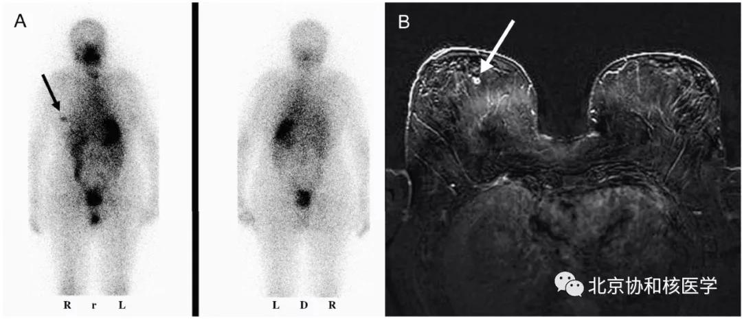 碘扫描最坏的结果,放射性核素扫描可以鉴别诊断吗