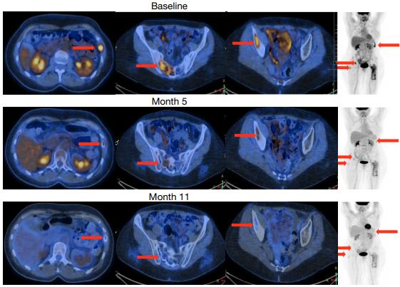 《自然》：模拟禁食或是治疗乳腺癌的“神助攻”！科学家发现模拟禁食能增强乳腺癌内分泌治疗疗效，延缓耐药的机制丨科学大发现