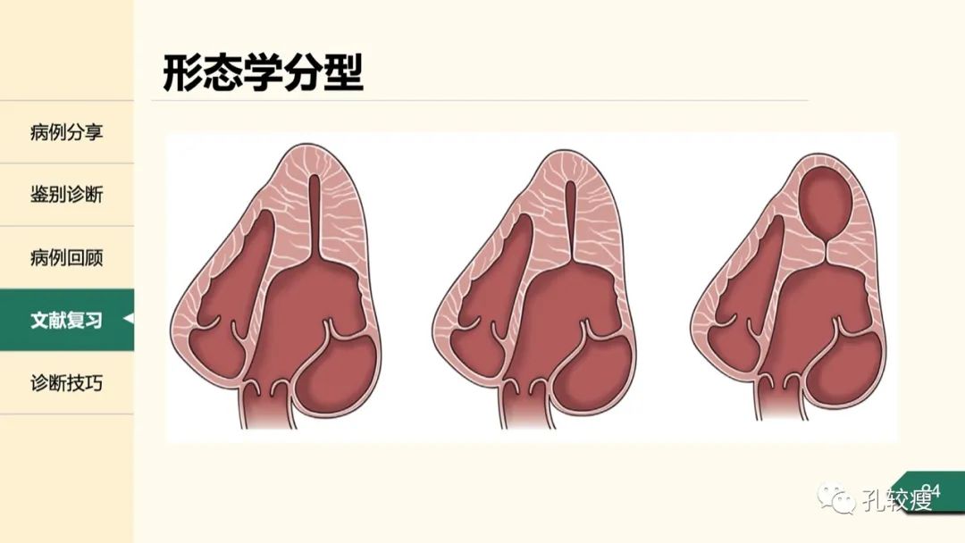 t波倒置在心电图中怎么看,T波低平心电图讲解