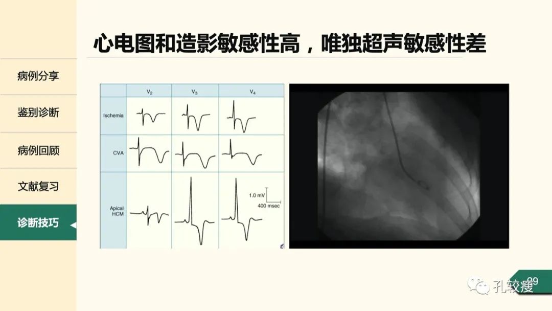t波倒置在心电图中怎么看,T波低平心电图讲解