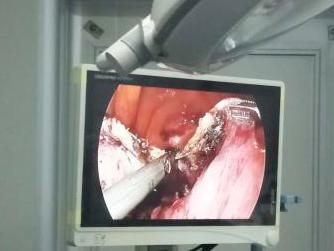 中年女士肚子大的跟怀孕一样,五岁小姑娘肚子突然变大了