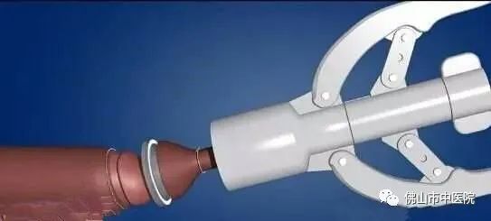 【干货】@家长，小孩包皮长这样该切，治疗的黄金时期是……