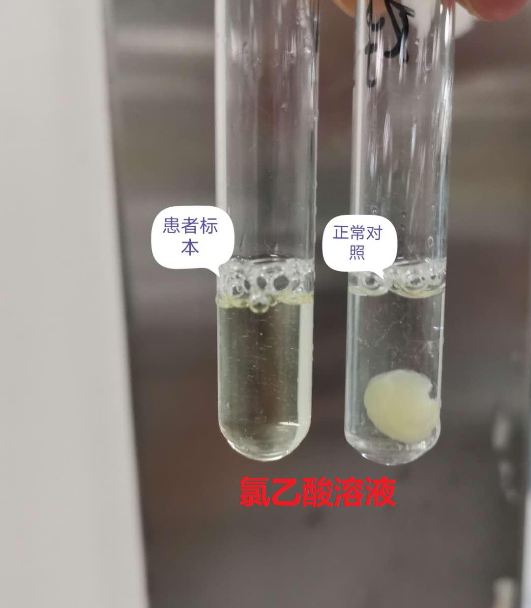 血栓弹力图和常规凝血四项区别,血栓弹力图试验凝血因子水平偏高