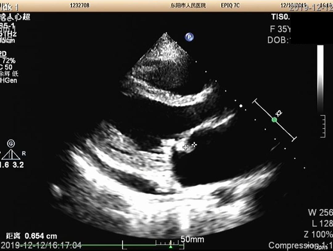 快看！心脏“漏了个洞”，人竟然还活着……
