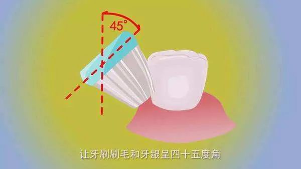 牙颈部楔状缺损,楔状缺损横沟修复