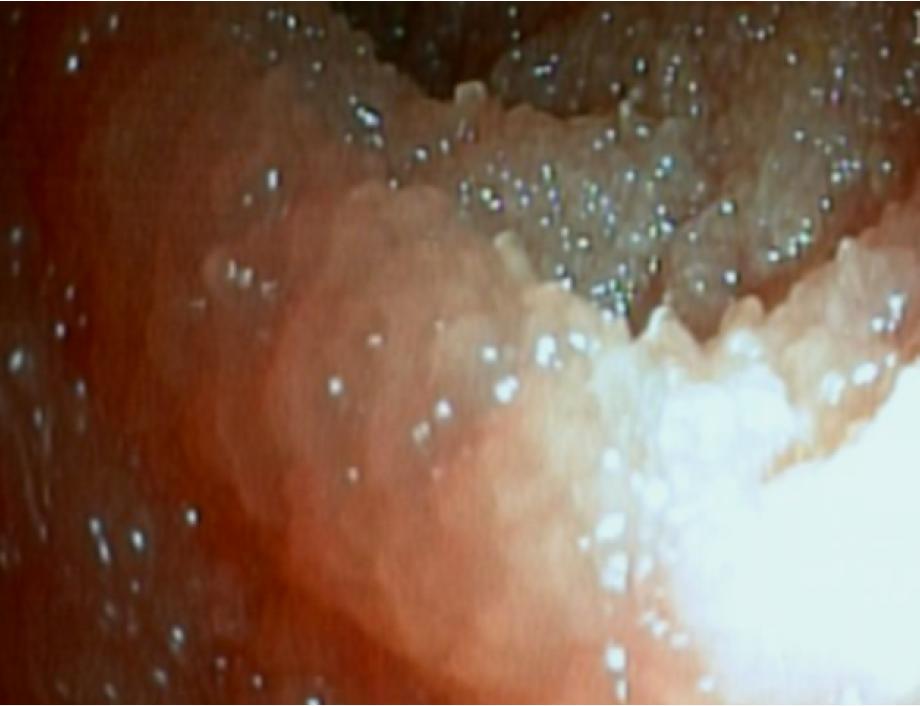 水样腹泻3个月伴发烧，这个病值得引起关注|病例学习