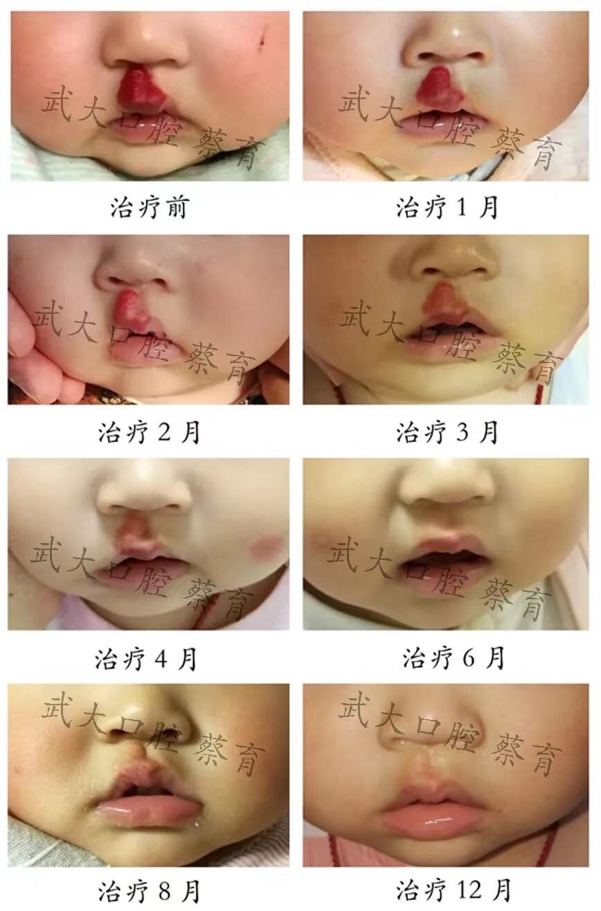 血管瘤八年了没有事可要治疗,30岁得了血管瘤怎么办