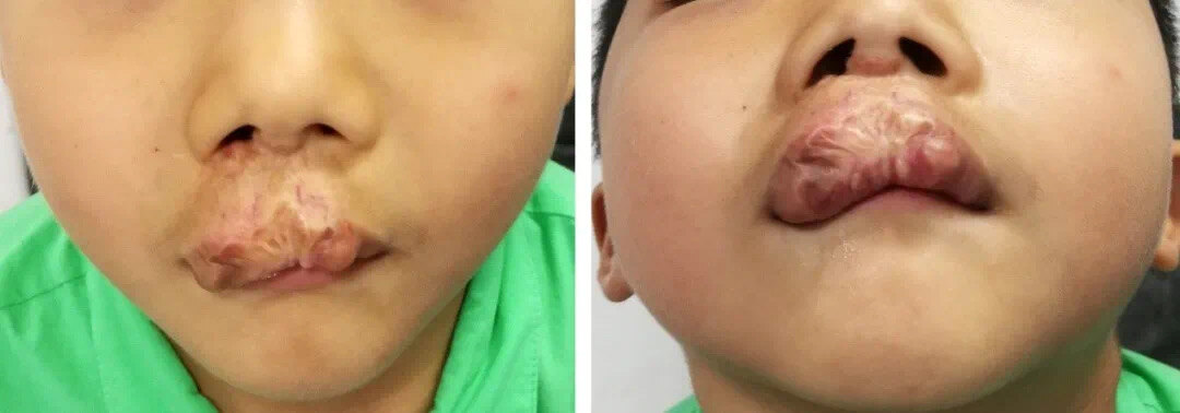 血管瘤八年了没有事可要治疗,30岁得了血管瘤怎么办