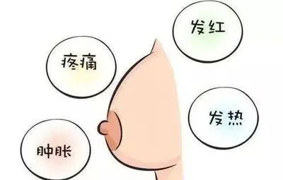 产后乳房涨奶,产后第一次涨奶