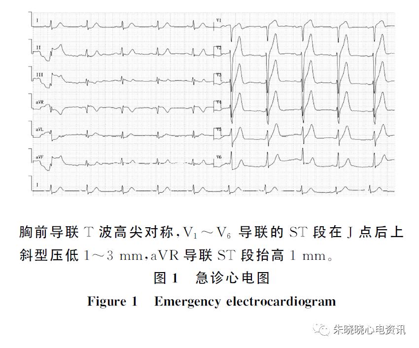 漏诊dewinter综合征,dewinter综合征相关心电图特点