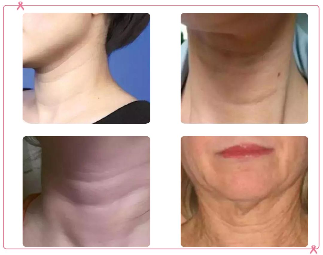 一条颈纹老十岁教你一招淡化,女人脖子有颈纹和年龄有关吗