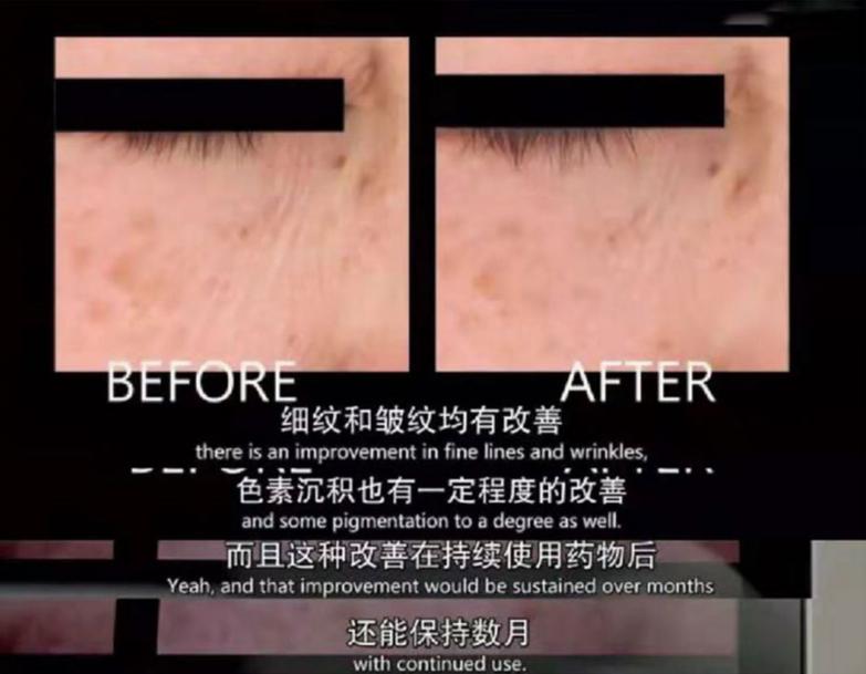 一条颈纹老十岁教你一招淡化,女人脖子有颈纹和年龄有关吗