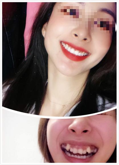 昆明龅牙矫正要多少钱,长沙轻微龅牙矫正要多少钱