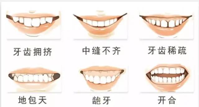昆明龅牙矫正要多少钱,长沙轻微龅牙矫正要多少钱