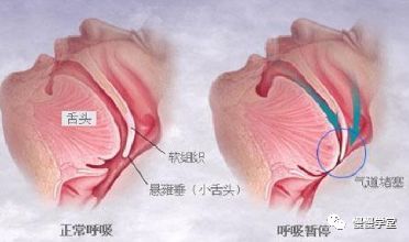 推荐学习|肥胖病人的机械通气策略