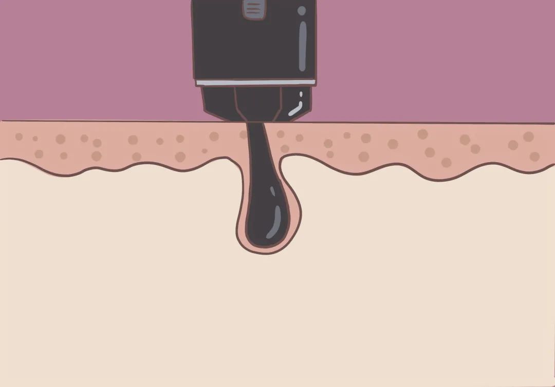 胸毛、脚趾毛、*处私**的毛能不能脱？一篇说清楚