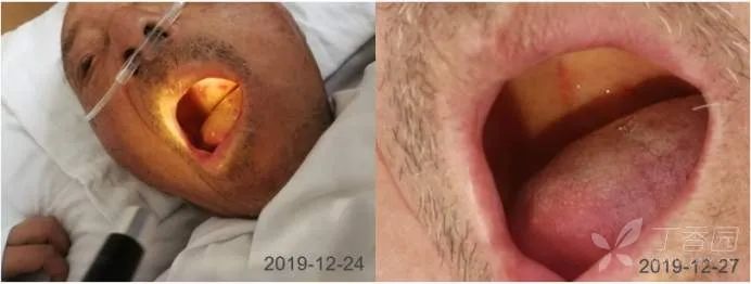 90岁老人面瘫怎么处理,老人面瘫轻度怎么治疗