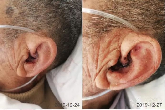 90岁老人面瘫怎么处理,老人面瘫轻度怎么治疗