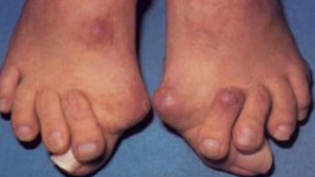 有类风湿症状没有类风湿因子,不是类风湿病吃类风湿药有啥症状