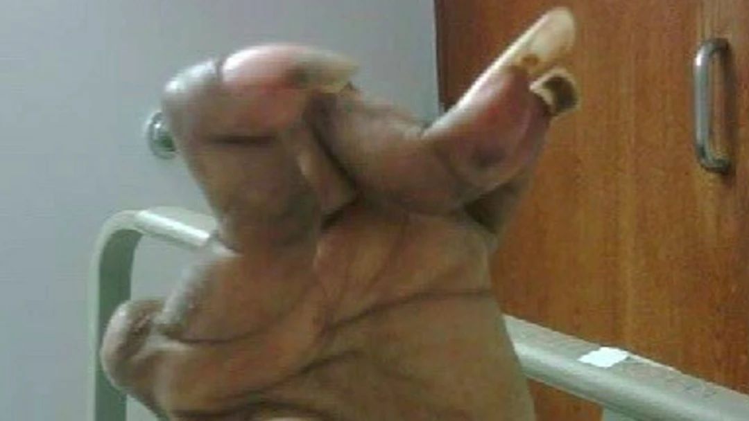 有类风湿症状没有类风湿因子,不是类风湿病吃类风湿药有啥症状