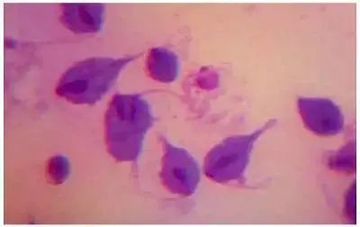 尿道感染滴虫有什么症状,尿道滴虫