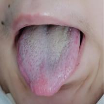 新冠病毒中医方案,新冠少阳辨证