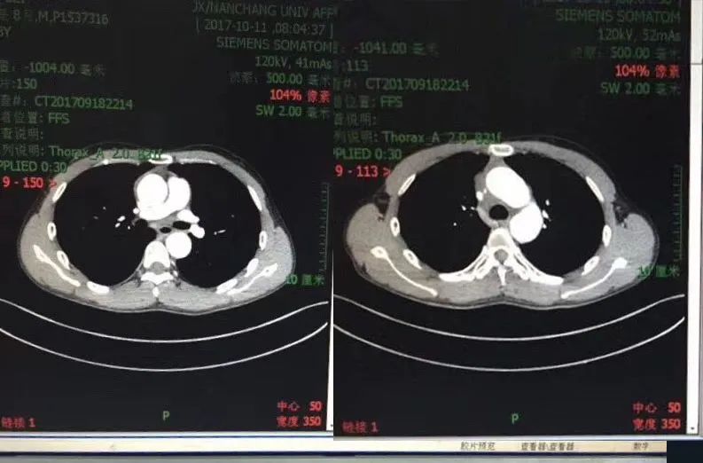 33岁小伙肝癌晚期，来到江西后……