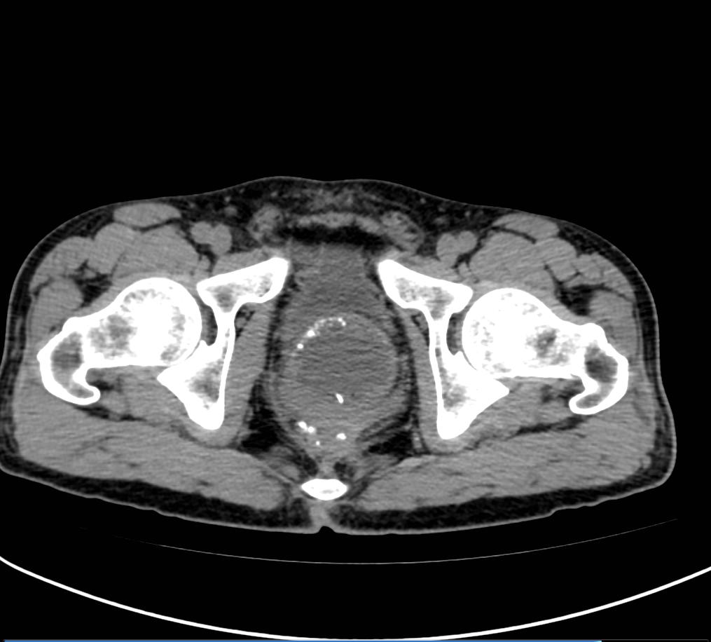 直肠癌保肛造口回肠手术风险大吗,直肠癌保肛手术吻合口狭窄