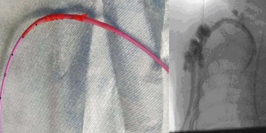 中心静脉导管血栓形成,中心静脉导管是什么