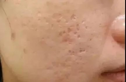 痘痘不再反复了怎么办,痘痘不消失怎么办