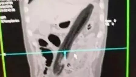 杯具！泸州男子竟将啤酒玻璃杯塞进肛门？塞入直肠的奇……