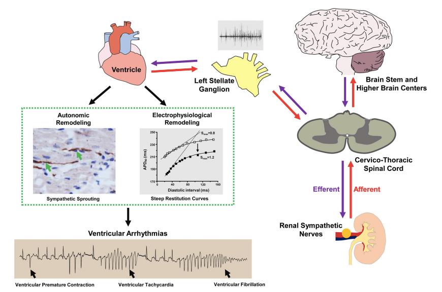 室速与室颤治疗上的区别,难治性室颤和室速