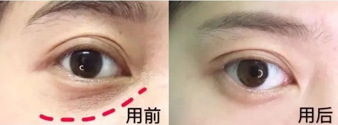 60岁没眼袋方法,教你一招去眼纹