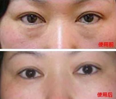 60岁没眼袋方法,教你一招去眼纹